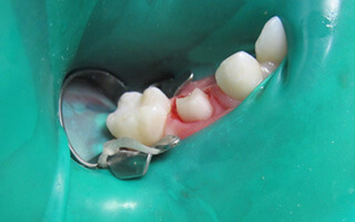 Closeup of damaged tooth prepared for restoration