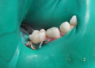 Close up of dental crown being cemented onto a tooth