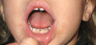 Close up of smile with crowded lower teeth