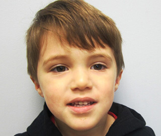 Boy after replacing upper tooth