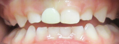 Close up of smile with chipped tooth