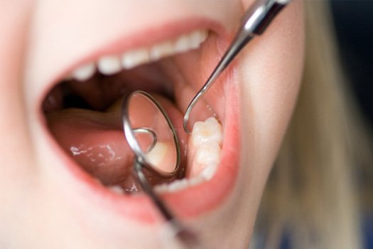 Closeup of dental mirror reflecting a child’s teeth during exam