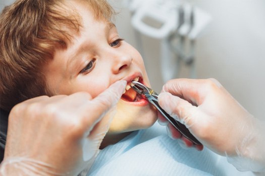 Gloved hands grasping little boy’s tooth with forceps