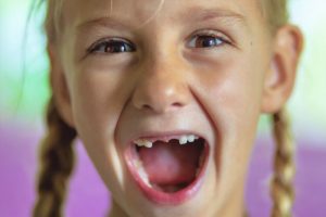 child smiling with lost baby teeth